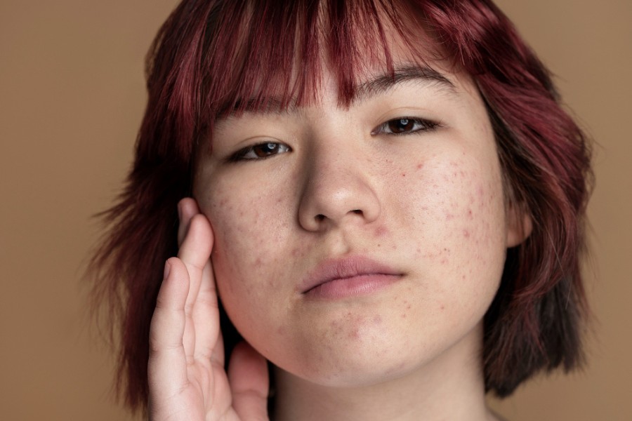 PEEL DA VI TẢO LÀ GÌ? CÓ TỐT KHÔNG? CÁC LƯU Ý KHI PEEL TẢO